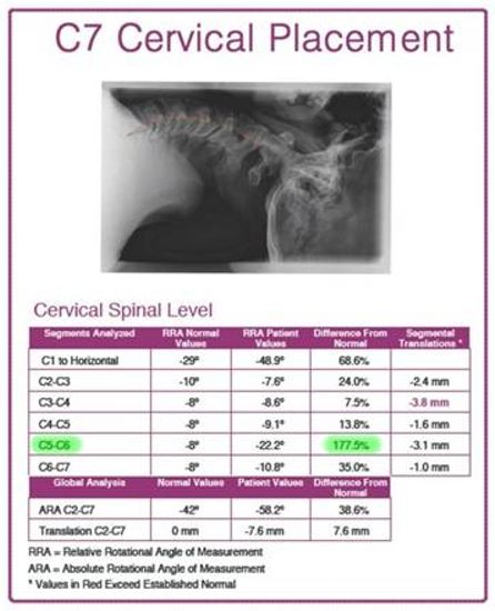 cervical c7