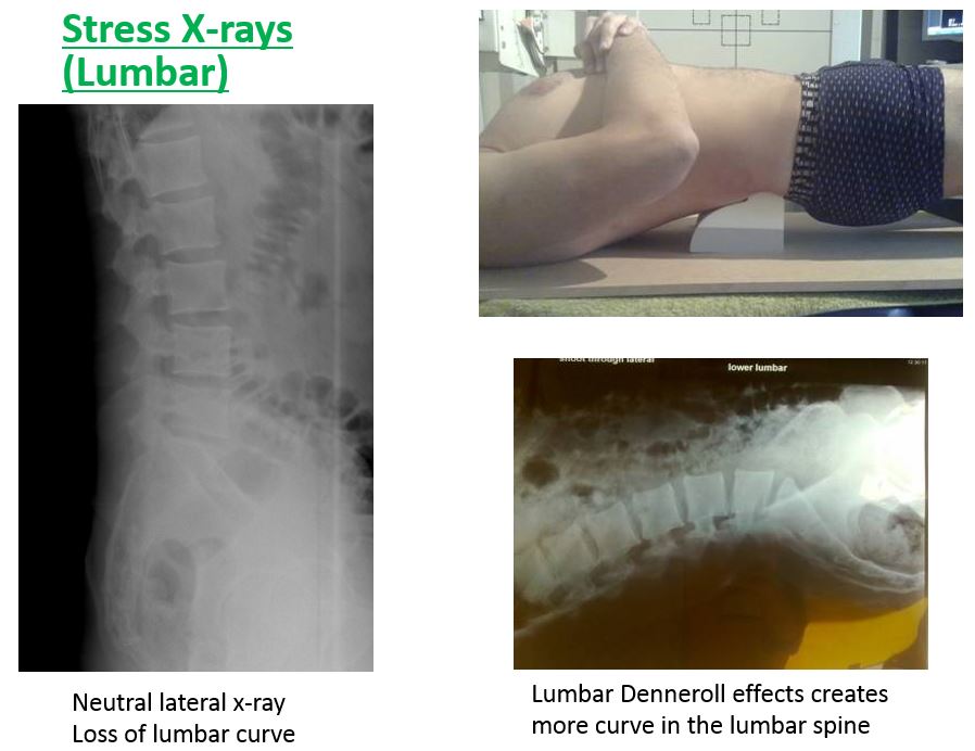 lumbar placements3